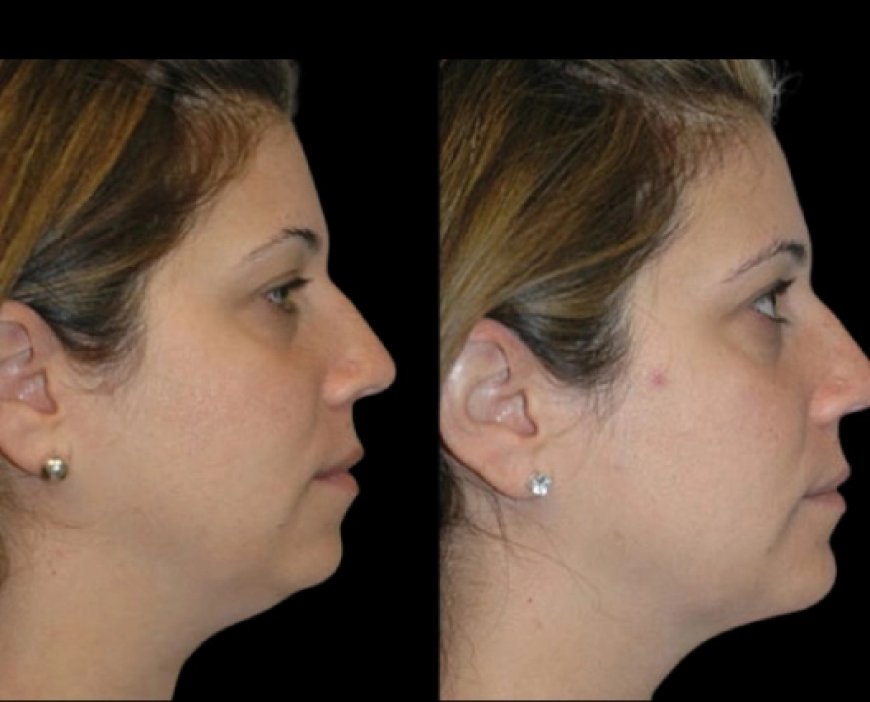 Double Chin Removal: How It Can Help You Age Gracefully, Explained by the Best Double Chin Removal Surgeon in Dubai