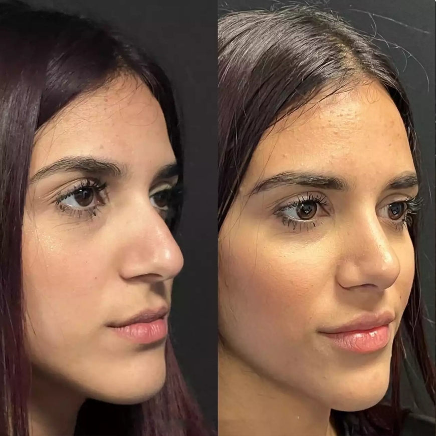 Best Septoplasty Surgeons in Dubai: What Sets Them Apart?