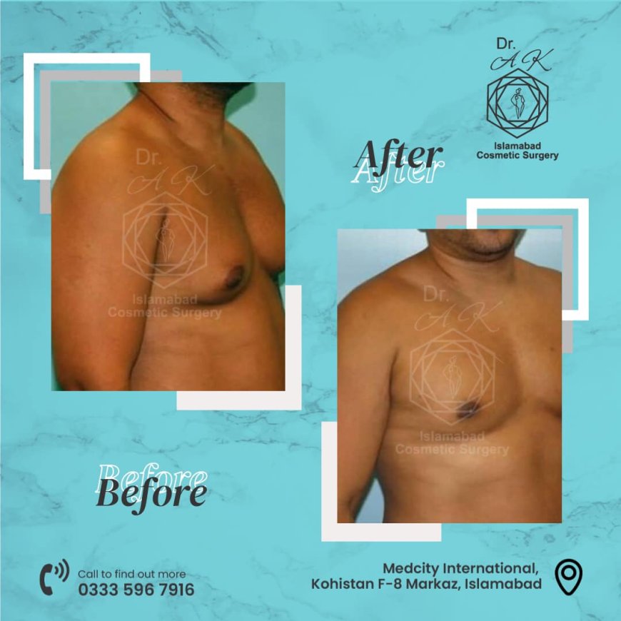 Expert Advice on Male Breast Reduction in Islamabad for Lasting Results