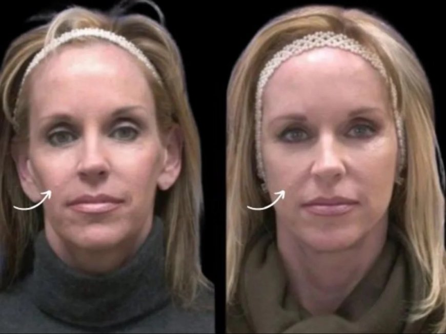 Cultural Perspectives: Sculptra Fillers Treatment in Dubai Among Expats & Locals