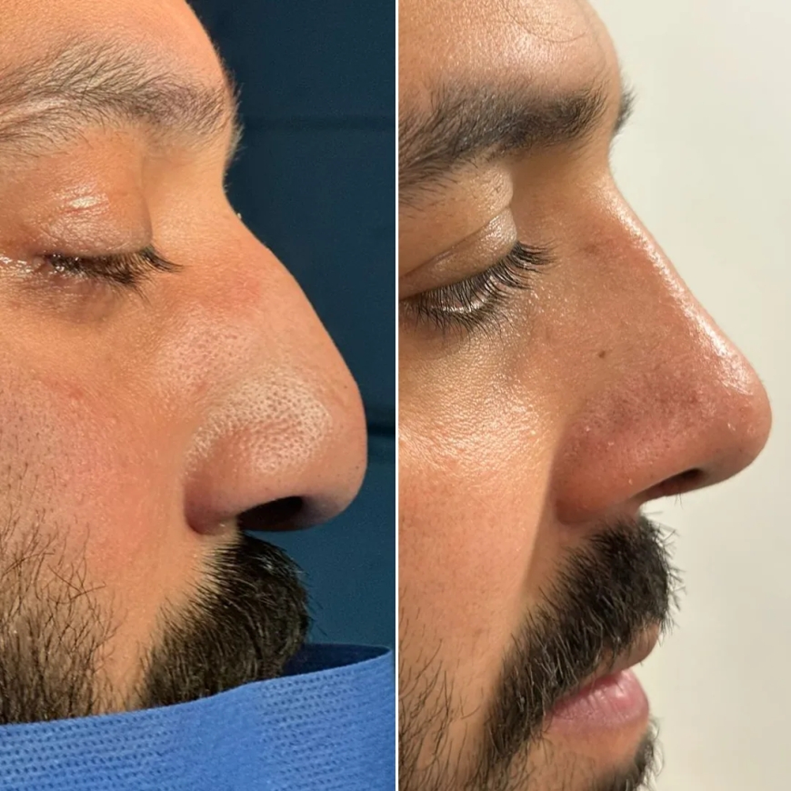 Everything You Need to Know About Rhinoplasty in Islamabad