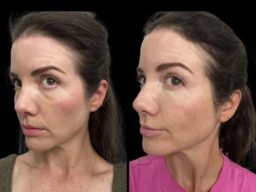 Dark Circles Treatment in Dubai: How Dermal Fillers Can Restore Youthful Eyes