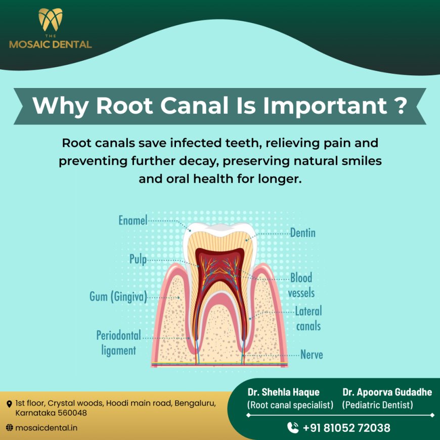 Best Root Canal Treatment in Hoodi Bangalore: Everything You Need to Know