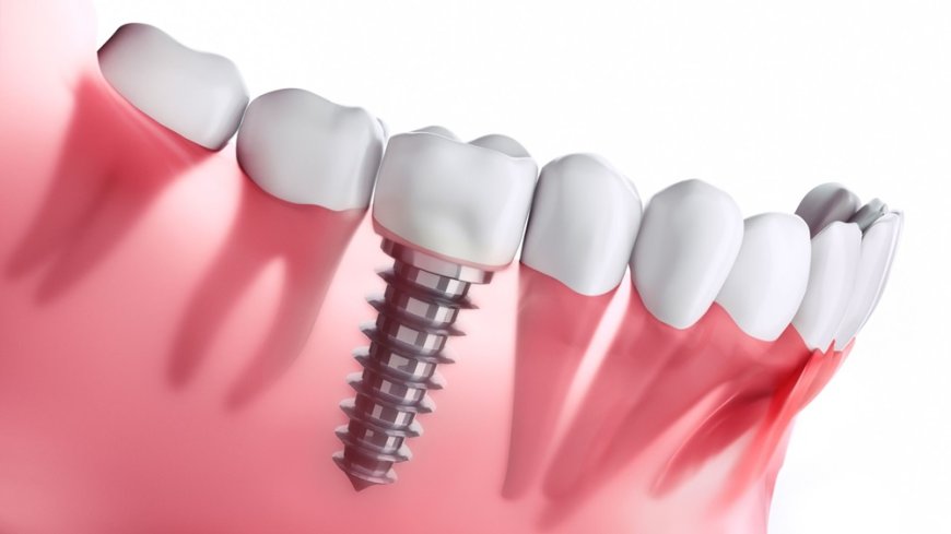 Restore Your Smile with Confidence: Get Custom Dental Implants at The Urban Dentist in Richmond