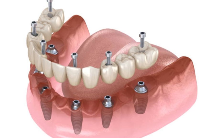 Discover the Benefits of Dental Implants Near You at Gateway Dentistry Group