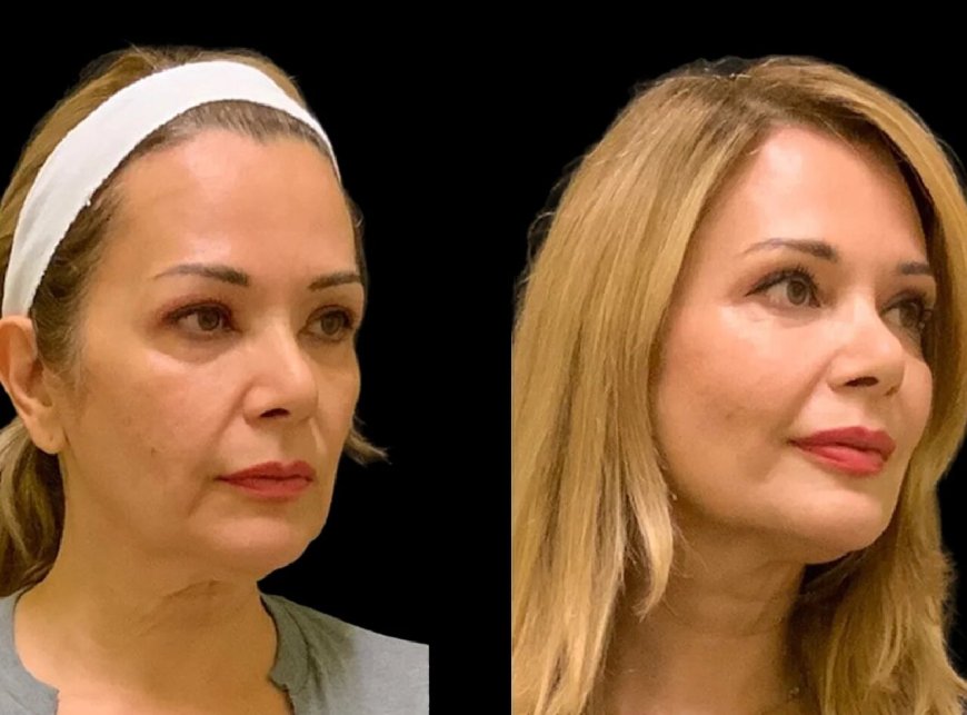Cheek Fillers: Find the Best Plastic Surgeon in Dubai for Your Dream Look