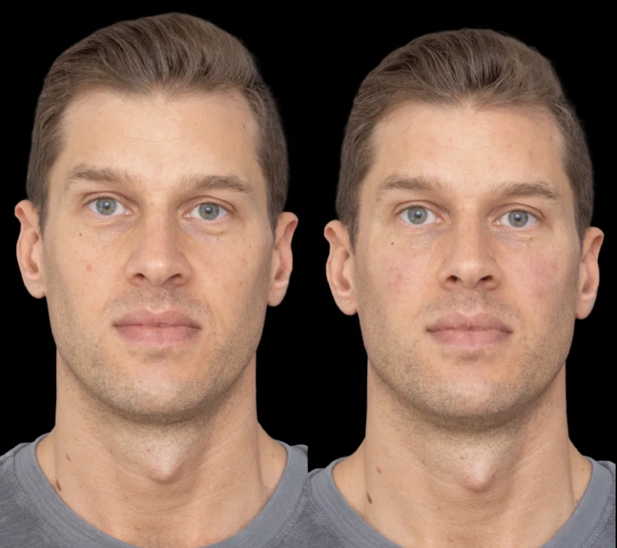 Get Glowing Skin with Under Eye Fillers from the Best Plastic Surgeon in Dubai